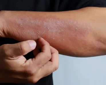 If you see these painful red bumps, you may have dyshidrotic eczema – Notebook 2025