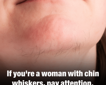 What Chin Whiskers Might Tell You About Your Health