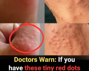 Doctors Are Alarmed: These Small Red Dots on Your Skin Could Be a Serious Warning Sign – Don’t Overlook Them