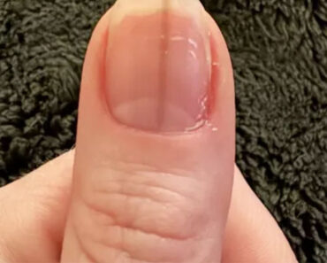 Woman told to see doctor immediately after sharing image of her thumb online