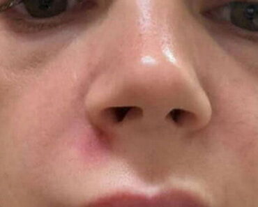 Woman hospitalised after popping spot in her ‘triangle of d.e.ath’ Woman hospitalised after popping spot in her ‘triangle of d.e.ath’