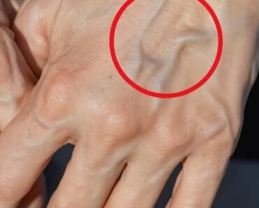 If you have visible veins it means you are…See more – Daily News