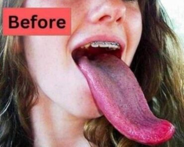Search Results for “White Tongue Explained Causes Care and Safe Remedies for a Healthy Mouth”​