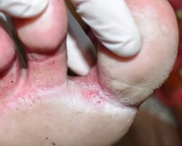 Looks like a infection between my toes. Can’t get medical advice for now. Any over-the