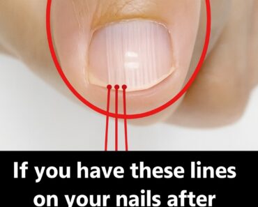 They look harmless, but these nail lines after 40 can actually tell a shocking story about your body. Details revealed in the first c0mment