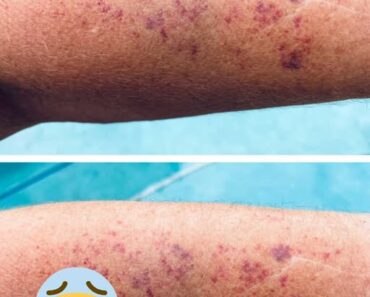 Purple blotches keep showing up on my arms. Doctor isn’t available for weeks. What should I do? Purple blotches keep showing up on my arms. Doctor isn’t available for weeks. What should I do?