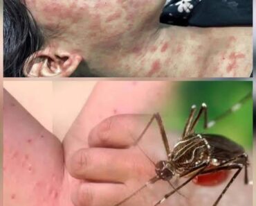 ALERT: New Disease Outbreak in China — Over 7,000 Cases Reported, Symptoms and Risks Revealed…see more