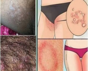 All the Symptoms of Stomach Cancer