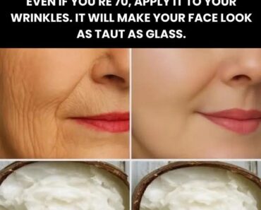 My aunt taught me how to prepare my own homemade cream to remove wrinkles and blackheads. Check 1st comment