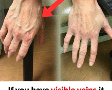 When to Worry About Veins That Appear Out of Nowhere
