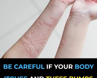 Surprising Causes Of Hives Revealed — What May Be Triggering Your Skin Reaction Surprising Causes Of Hives Revealed — What May Be Triggering Your Skin Reaction