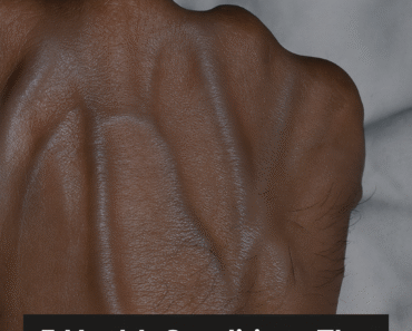 5 Health Conditions That Can Make Your Veins More Noticeable