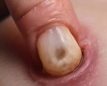 Body Acne: 10 Tips To Get Rid Of Them Body Acne: 10 Tips To Get Rid Of Them