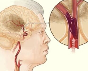 7 Habits That Help Reduce the Risk of Aneurysm