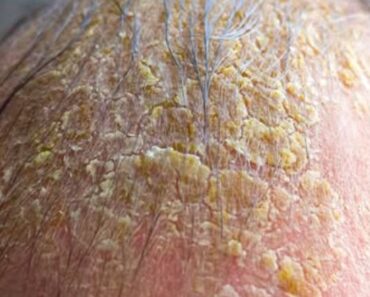 Oozing yellow crust on my scalp won’t cure. Clinic waitlist is long. What is it? Oozing yellow crust on my scalp won’t cure. Clinic waitlist is long. What is it?