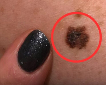 4 Types of Pimples That Could Be a “Disguise” for Can.cer 4 Types of Pimples That Could Be a “Disguise” for Can.cer