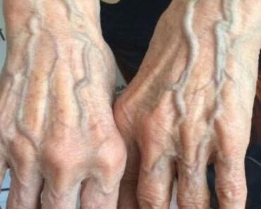 When to Worry About Veins That Appear Ou