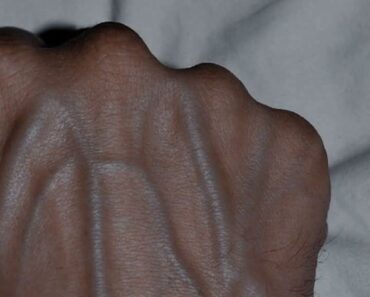 If your veins are visible in your hand, it is a signal of ca