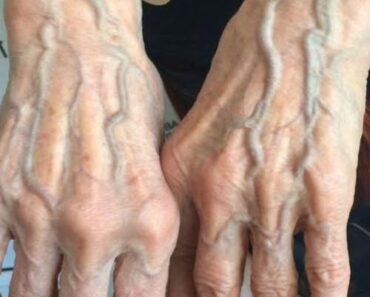 When to Worry About Veins That Appear Out of Nowhere