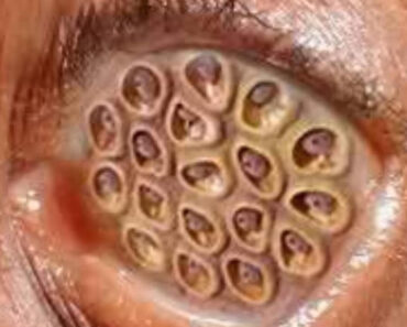 Signs and Prevention Tips for Adult Ear Infections