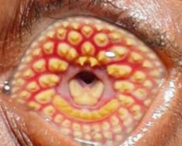 Body Acne: Tips To Get Rid Of Them