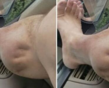 What Do Leg Cramps Reveal About Your Kidney Health? What Do Leg Cramps Reveal About Your Kidney Health?