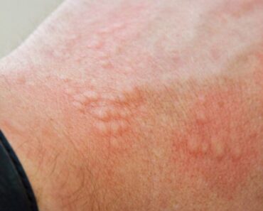 How to Reduce Skin Irritation: Causes, Remedies, and Prevention Tips