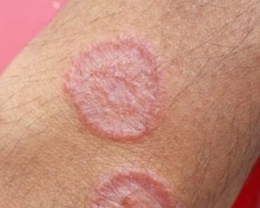 5 Simple Home Remedies to Prevent Ringworm and Keep Your Skin Healthy