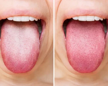 If you have a white tongue, it means that your… See more – Daily News If you have a white tongue, it means that your… See more – Daily News