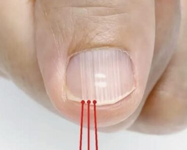 What Those Vertical Ridges on Yo