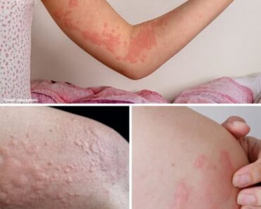HT15. If your body itches and these bumps appear on your skin… See more