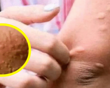 His whole body was itchy, he thought it was an allergy and was diagnosed