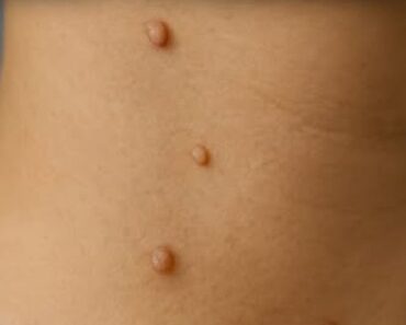 The Most Common Spots for Skin Tags and Why They Form There